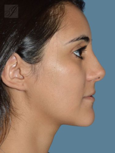 after rhinoplasty side view female patient case 2