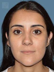 after rhinoplasty front view female patient case 2