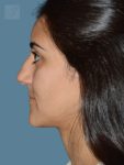 before rhinoplasty left side view female patient case 2
