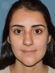 before rhinoplasty front view female patient case 2