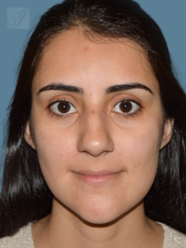 before rhinoplasty front view female patient case 2