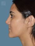 after rhinoplasty left side view female patient case 2