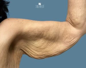 before arm lift front view female patient case 10710