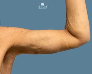 after arm lift front view female patient case 10710