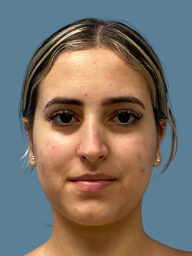 before rhinoplasty front view female case 10455