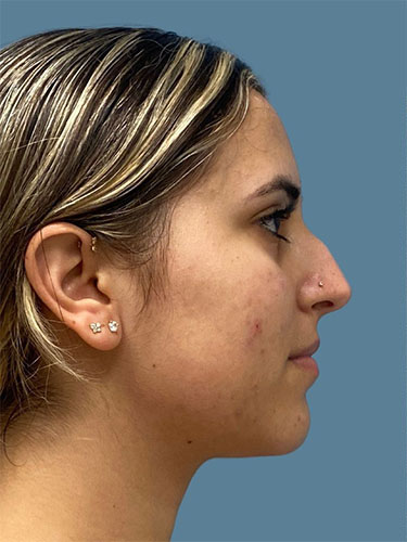 before rhinoplasty side view female case 10455