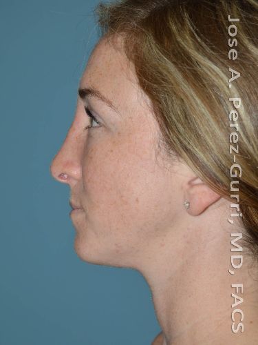 after rhinoplasty left side view female case 9352