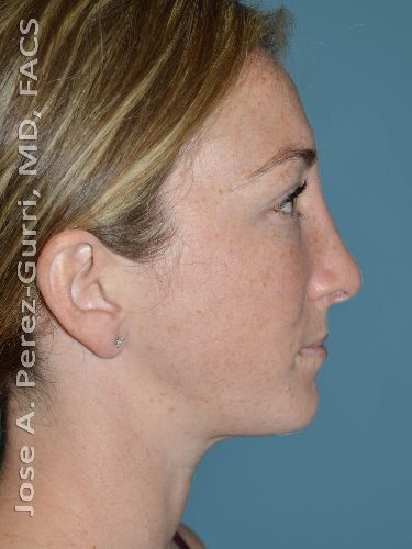 after rhinoplasty side view female case 9352