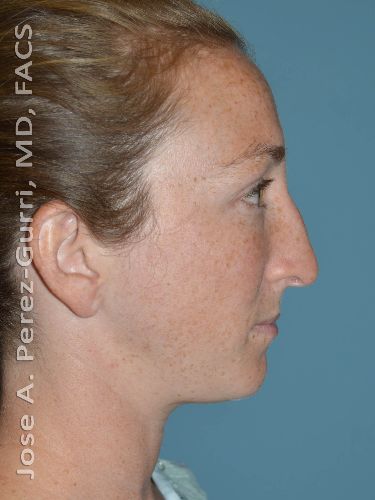 before rhinoplasty side view female case 9352